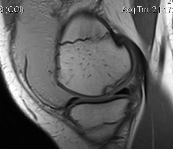 Lipoma Arborescens OCD